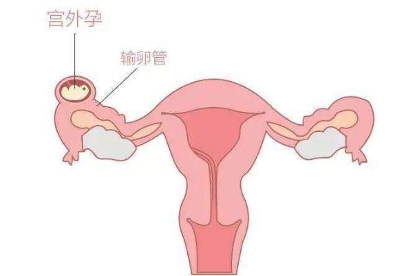宮外孕的癥狀有哪些表現(xiàn) 宮外孕怎么辦處理方法 宮外孕的癥狀有哪些表現(xiàn) 宮外孕怎么辦處理方法