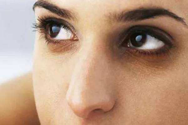 黑眼圈很嚴(yán)重怎么回事 黑眼圈很嚴(yán)重是得病了嗎 黑眼圈很嚴(yán)重怎么回事 黑眼圈很嚴(yán)重是得病了嗎