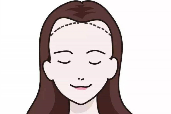 發(fā)際線會(huì)遺傳嗎 發(fā)際線會(huì)不會(huì)越來越高
