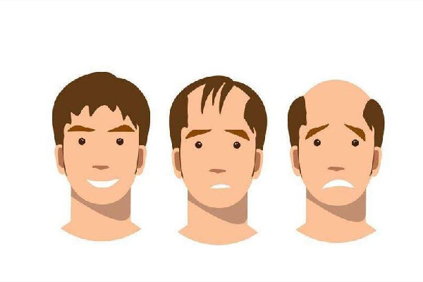 發(fā)際線會(huì)長(zhǎng)回來(lái)嗎 發(fā)際線和年齡有關(guān)系嗎