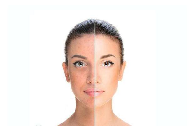 皮膚暗黃吃什么維生素比較好 皮膚暗黃粗糙毛孔大怎么改善 皮膚暗黃吃什么維生素比較好 皮膚暗黃粗糙毛孔大怎么改善