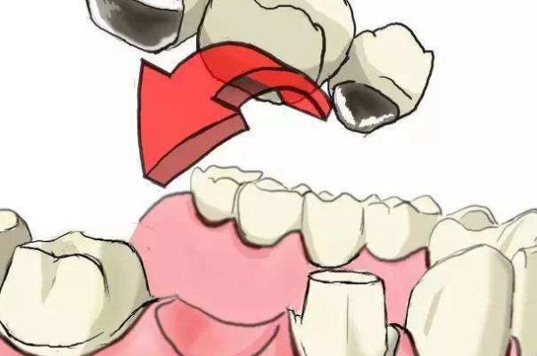 鑲牙的壽命是多長(zhǎng)時(shí)間 鑲牙的危害 鑲牙的壽命是多長(zhǎng)時(shí)間 鑲牙的危害