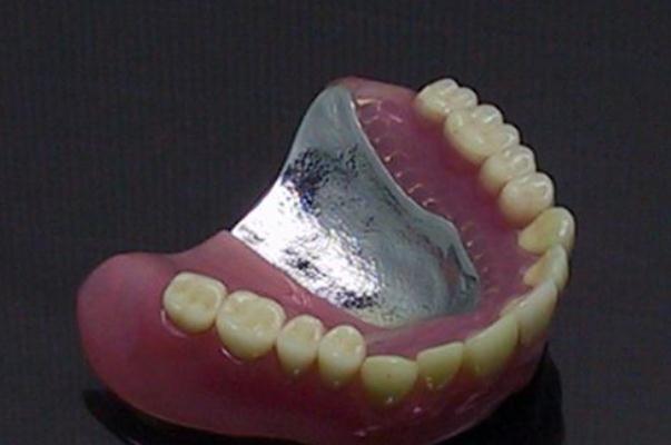 鑲牙要把牙根拔掉嗎 鑲牙有幾種方式哪個好