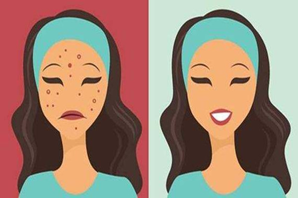 痘痘擠了之后怎么處理 痘痘擠了之后會(huì)留痘印嗎 痘痘擠了之后怎么處理 痘痘擠了之后會(huì)留痘印嗎