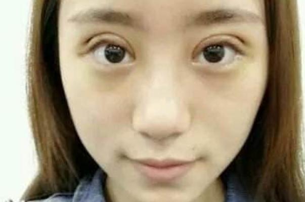 割雙眼皮后不能吃什么 割雙眼皮的后遺癥 割雙眼皮后不能吃什么 割雙眼皮的后遺癥