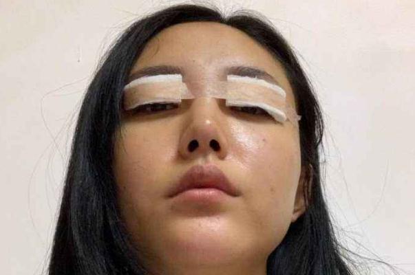 割雙眼皮有哪些風(fēng)險(xiǎn) 割雙眼皮有哪些副作用 割雙眼皮有哪些風(fēng)險(xiǎn) 割雙眼皮有哪些副作用