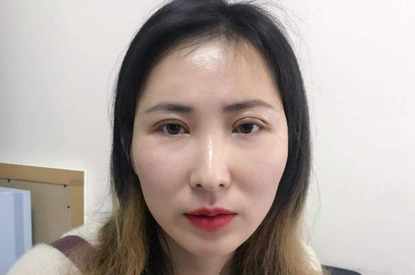 割雙眼皮對(duì)視力有影響嗎 割雙眼皮可以維持一輩子嗎