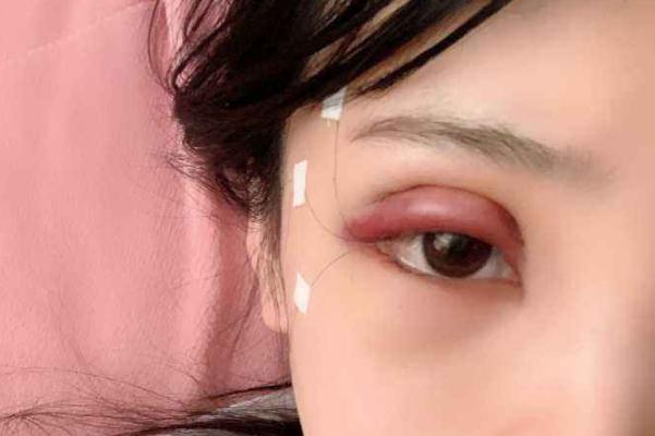 割雙眼皮對(duì)視力有影響嗎 割雙眼皮可以維持一輩子嗎