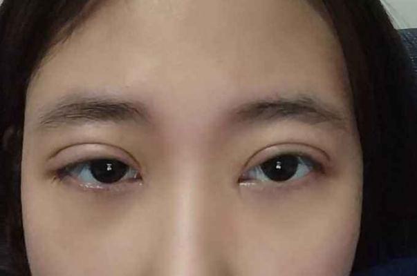 割雙眼皮有哪些風(fēng)險(xiǎn) 割雙眼皮有哪些副作用 割雙眼皮有哪些風(fēng)險(xiǎn) 割雙眼皮有哪些副作用