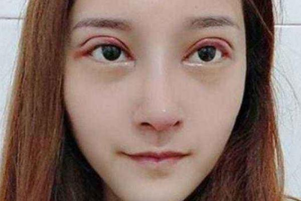 割雙眼皮有哪些風(fēng)險(xiǎn) 割雙眼皮有哪些副作用 割雙眼皮有哪些風(fēng)險(xiǎn) 割雙眼皮有哪些副作用