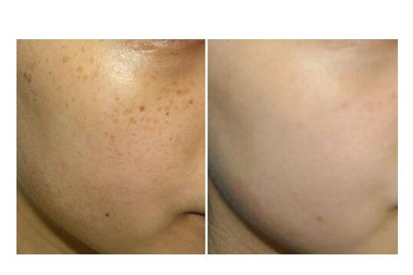 皮秒祛斑的副作用 皮秒祛斑的效果會反彈嗎 皮秒祛斑的副作用 皮秒祛斑的效果會反彈嗎