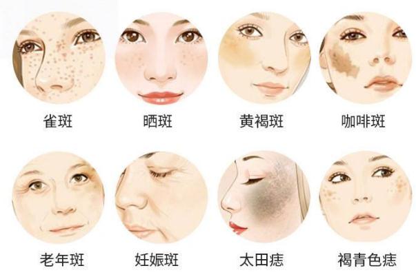 皮秒祛斑后期要怎樣護理 皮秒祛斑反黑多久能恢復(fù)正常 皮秒祛斑后期要怎樣護理 皮秒祛斑反黑多久能恢復(fù)正常