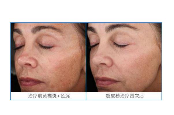 皮秒祛斑要間隔多長時間做一次 皮秒祛斑要敷麻藥嗎 皮秒祛斑要間隔多長時間做一次 皮秒祛斑要敷麻藥嗎
