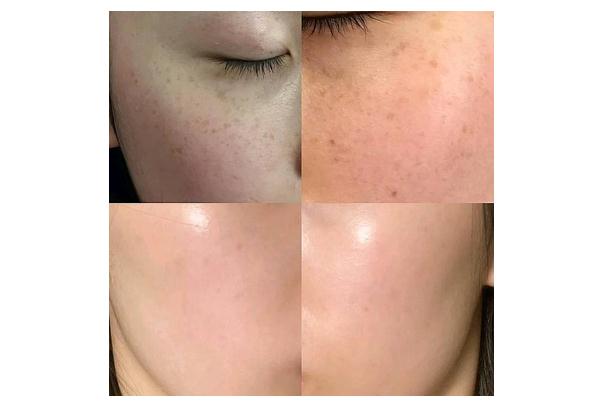 皮秒祛斑后期要怎樣護理 皮秒祛斑反黑多久能恢復(fù)正常 皮秒祛斑后期要怎樣護理 皮秒祛斑反黑多久能恢復(fù)正常