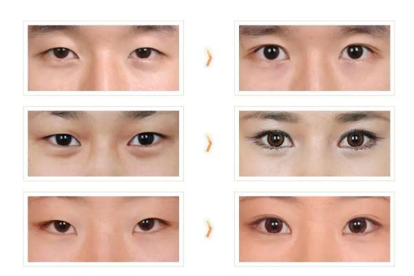 開眼角的恢復(fù)期是多久 開眼角要多久才能恢復(fù)正常