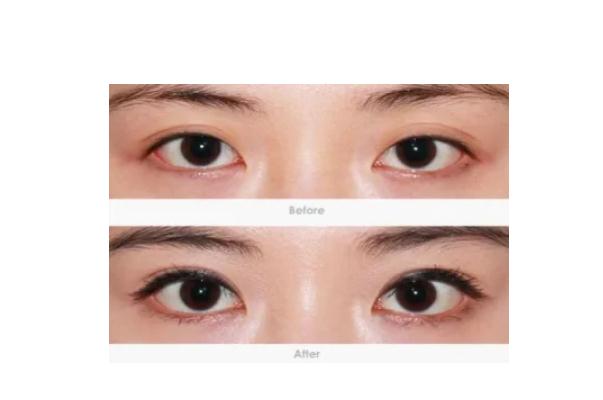 開眼角的副作用 開眼角的線沒(méi)拆干凈有影響嗎