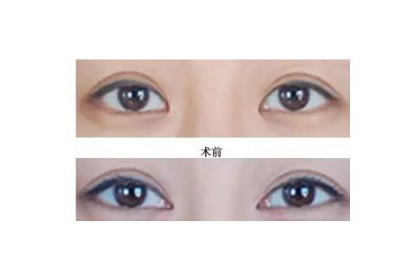 開眼角可以修復(fù)原樣嗎 開眼角可以做第二次嗎 開眼角可以修復(fù)原樣嗎 開眼角可以做第二次嗎