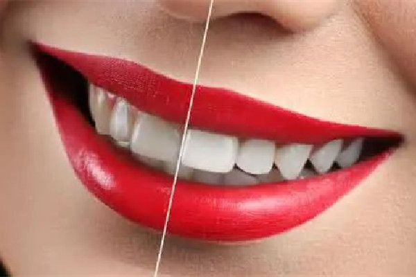 牙齒美白哪種方法好 牙齒美白有幾種方式 牙齒美白哪種方法好 牙齒美白有幾種方式