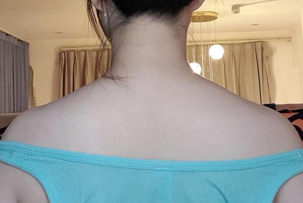 瘦肩針可以消除富貴包嗎 瘦肩針對頸椎有好處嗎 瘦肩針可以消除富貴包嗎 瘦肩針對頸椎有好處嗎