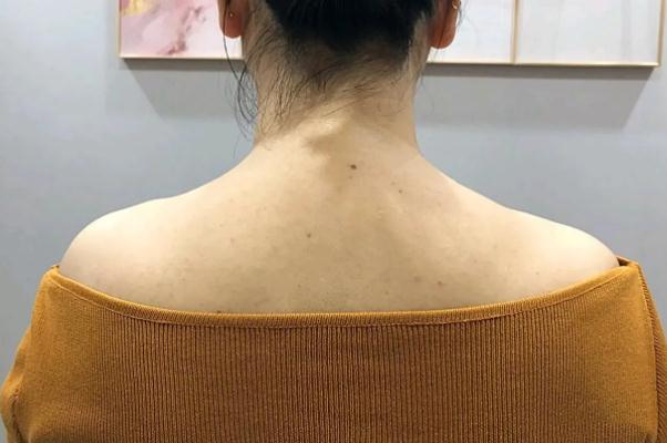 瘦肩針要打多少單位 瘦肩針要敷麻藥嗎 瘦肩針要打多少單位 瘦肩針要敷麻藥嗎