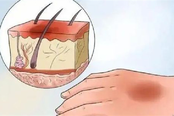 祛疤手術(shù)后要戒辛辣多長時(shí)間 祛疤手術(shù)后不能吃什么