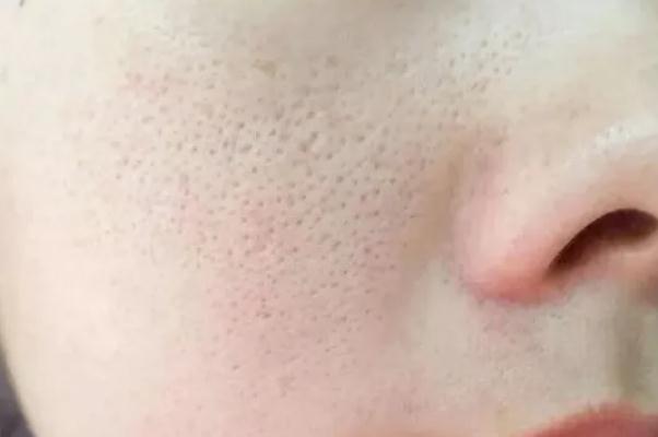 毛孔粗大怎么辦怎么收縮毛孔 毛孔粗大用什么護(hù)膚品可以改善 毛孔粗大怎么辦怎么收縮毛孔 毛孔粗大用什么護(hù)膚品可以改善