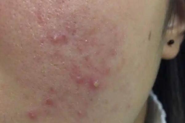 毛孔粗大會自己好嗎 毛孔粗大會導(dǎo)致什么后果 毛孔粗大會自己好嗎 毛孔粗大會導(dǎo)致什么后果