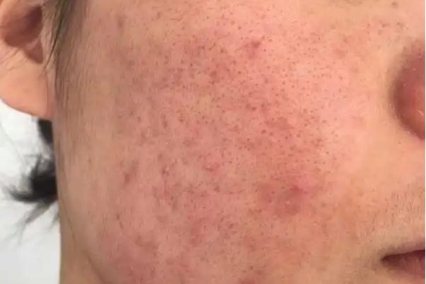 毛孔粗大有痘坑怎么修復(fù) 毛孔粗大有幾種類型 毛孔粗大有痘坑怎么修復(fù) 毛孔粗大有幾種類型