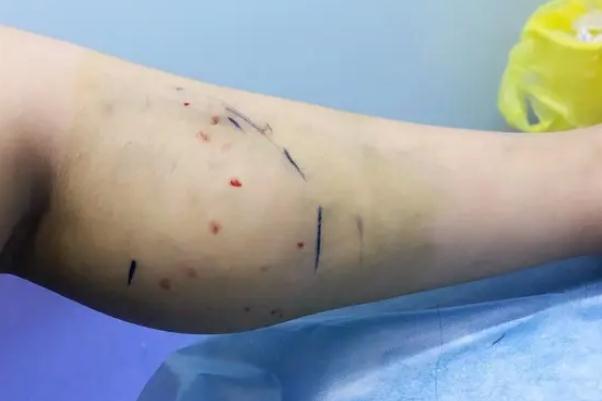瘦腿針對(duì)脂肪腿有效果嗎 瘦腿針對(duì)身體有傷害嗎 瘦腿針對(duì)脂肪腿有效果嗎 瘦腿針對(duì)身體有傷害嗎