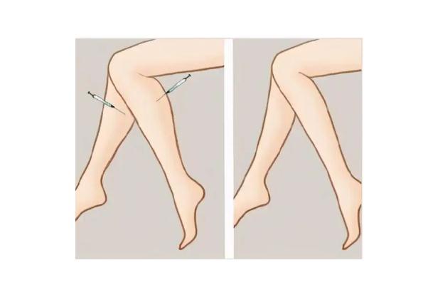 瘦腿針真的能瘦腿嗎 瘦腿針有沒有副作用