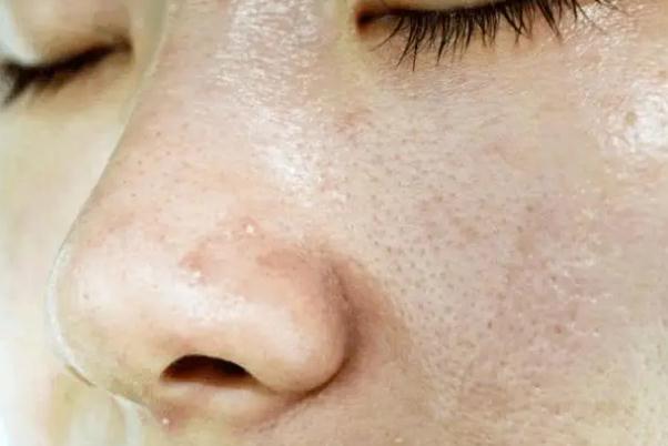 毛孔粗大有痘坑怎么修復(fù) 毛孔粗大有幾種類型 毛孔粗大有痘坑怎么修復(fù) 毛孔粗大有幾種類型