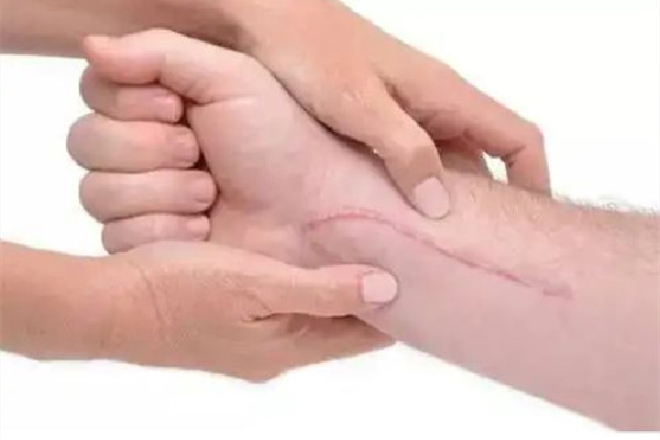 祛疤手術(shù)會(huì)疼嗎 祛疤手術(shù)做完多久可以洗澡 祛疤手術(shù)會(huì)疼嗎 祛疤手術(shù)做完多久可以洗澡