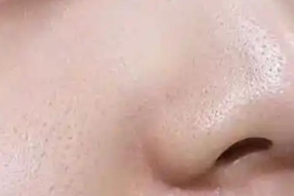 毛孔粗大可以刷酸嗎 毛孔粗大可以看皮膚科嗎 毛孔粗大可以刷酸嗎 毛孔粗大可以看皮膚科嗎