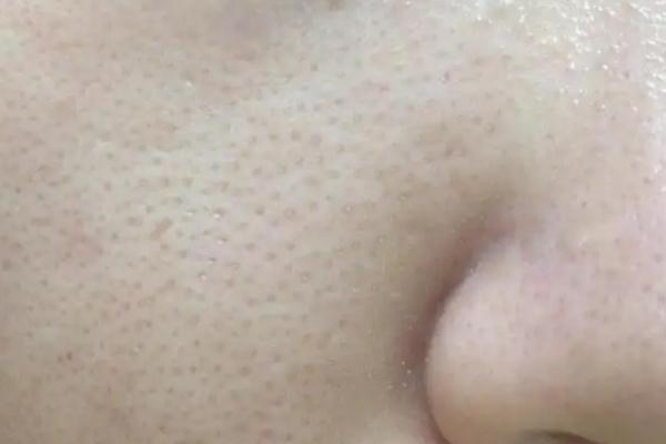 毛孔粗大是缺乏什么維生素 毛孔粗大是什么意思 毛孔粗大是缺乏什么維生素 毛孔粗大是什么意思