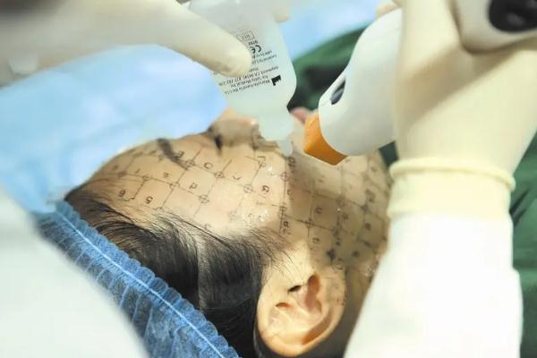 熱瑪吉會讓玻尿酸消失嗎 熱瑪吉會傷到面部神經(jīng)嗎 熱瑪吉會讓玻尿酸消失嗎 熱瑪吉會傷到面部神經(jīng)嗎