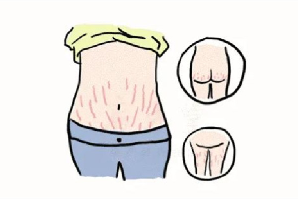 妊娠紋怎么可以徹底消除 妊娠紋是怎么引起的 妊娠紋怎么可以徹底消除 妊娠紋是怎么引起的