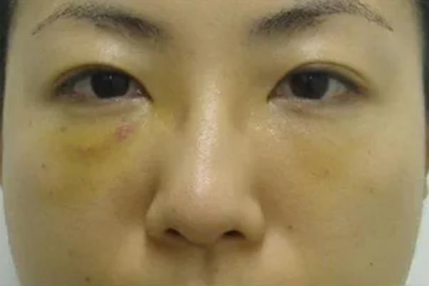 去眼袋手術(shù)要住院嗎 去眼袋手術(shù)要休息多久 去眼袋手術(shù)要住院嗎 去眼袋手術(shù)要休息多久