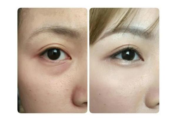 去眼袋手術(shù)要住院嗎 去眼袋手術(shù)要休息多久 去眼袋手術(shù)要住院嗎 去眼袋手術(shù)要休息多久