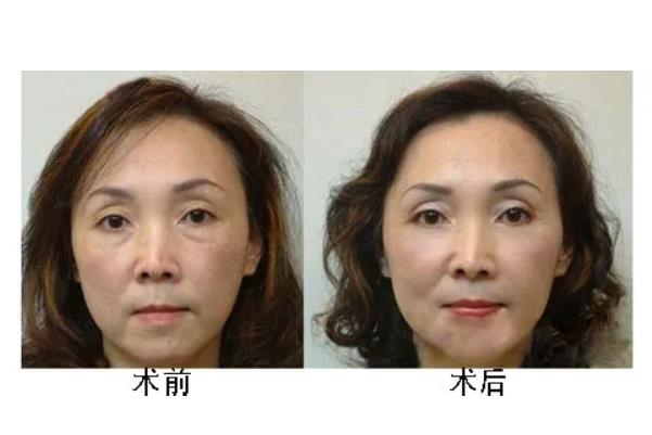 去眼袋手術(shù)后注意事項(xiàng) 去眼袋手術(shù)要多久恢復(fù)正常 去眼袋手術(shù)后注意事項(xiàng) 去眼袋手術(shù)要多久恢復(fù)正常