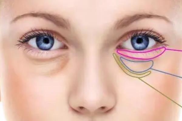 去眼袋手術(shù)要住院嗎 去眼袋手術(shù)要休息多久 去眼袋手術(shù)要住院嗎 去眼袋手術(shù)要休息多久