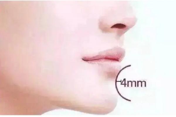 玻尿酸豐下巴多久恢復自然 玻尿酸豐下巴后遺癥 玻尿酸豐下巴多久恢復自然 玻尿酸豐下巴后遺癥