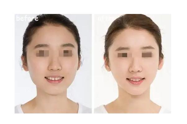 豐下巴哪種方法最好 豐下巴需要多少錢(qián)