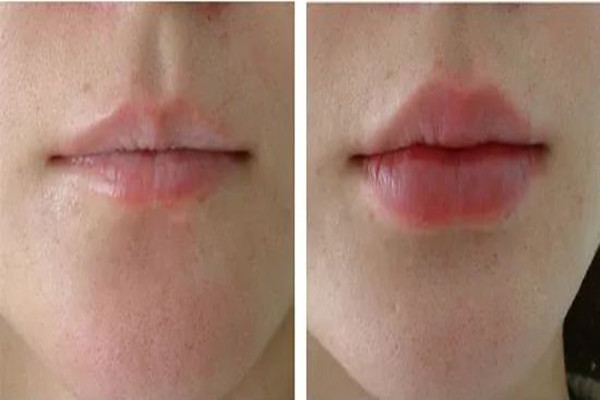 豐唇大概要多少錢 豐唇有哪些方法 豐唇大概要多少錢 豐唇有哪些方法