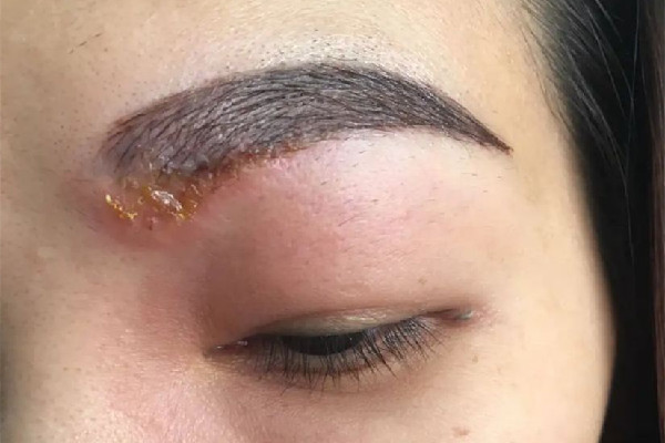 激光洗眉一般多少錢(qián) 激光洗眉去醫(yī)院還是美容院