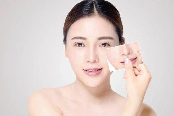 刷酸可以改變毛孔粗大嗎 刷酸的功效和作用 刷酸可以改變毛孔粗大嗎 刷酸的功效和作用