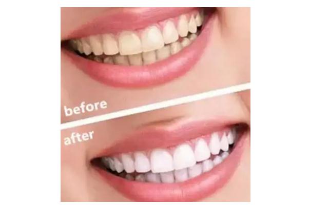 冷光美白牙齒要做幾次 牙齒冷光美白的機(jī)理 冷光美白牙齒要做幾次 牙齒冷光美白的機(jī)理