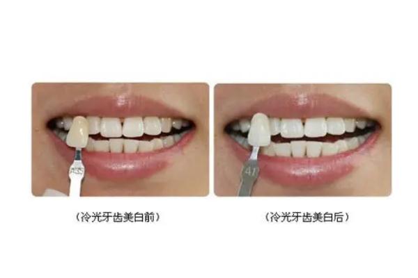 冷光美白牙齒要做幾次 牙齒冷光美白的機(jī)理 冷光美白牙齒要做幾次 牙齒冷光美白的機(jī)理