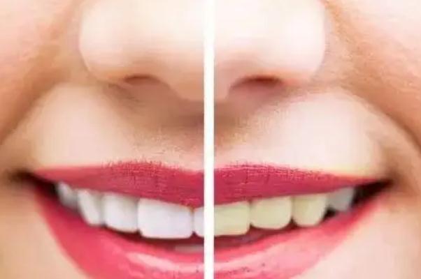 冷光美白牙齒會(huì)很白嗎 冷光美白牙齒對(duì)四環(huán)素牙有用嗎 冷光美白牙齒會(huì)很白嗎 冷光美白牙齒對(duì)四環(huán)素牙有用嗎