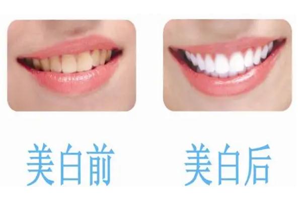 冷光美白牙齒后悔了 冷光美白牙齒的副作用 冷光美白牙齒后悔了 冷光美白牙齒的副作用