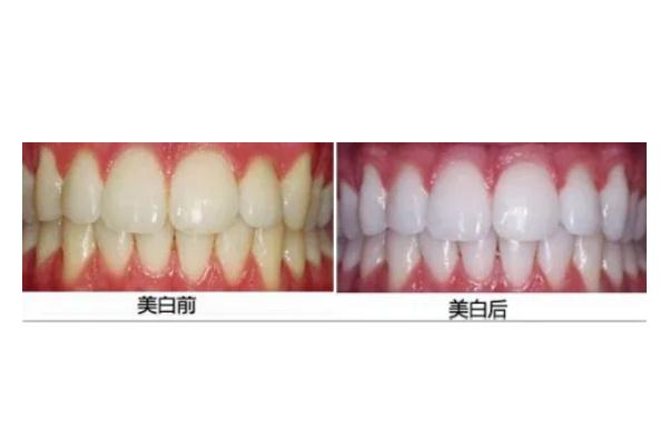 冷光美白牙齒是立馬見效嗎 冷光美白牙齒是紫外線照射嗎